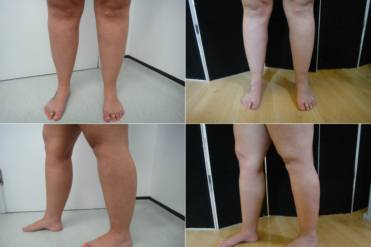 Patient1 Before After Lipo Cankles Lipoedema Calves Microlipo Dr Puneet Gupta Breast 