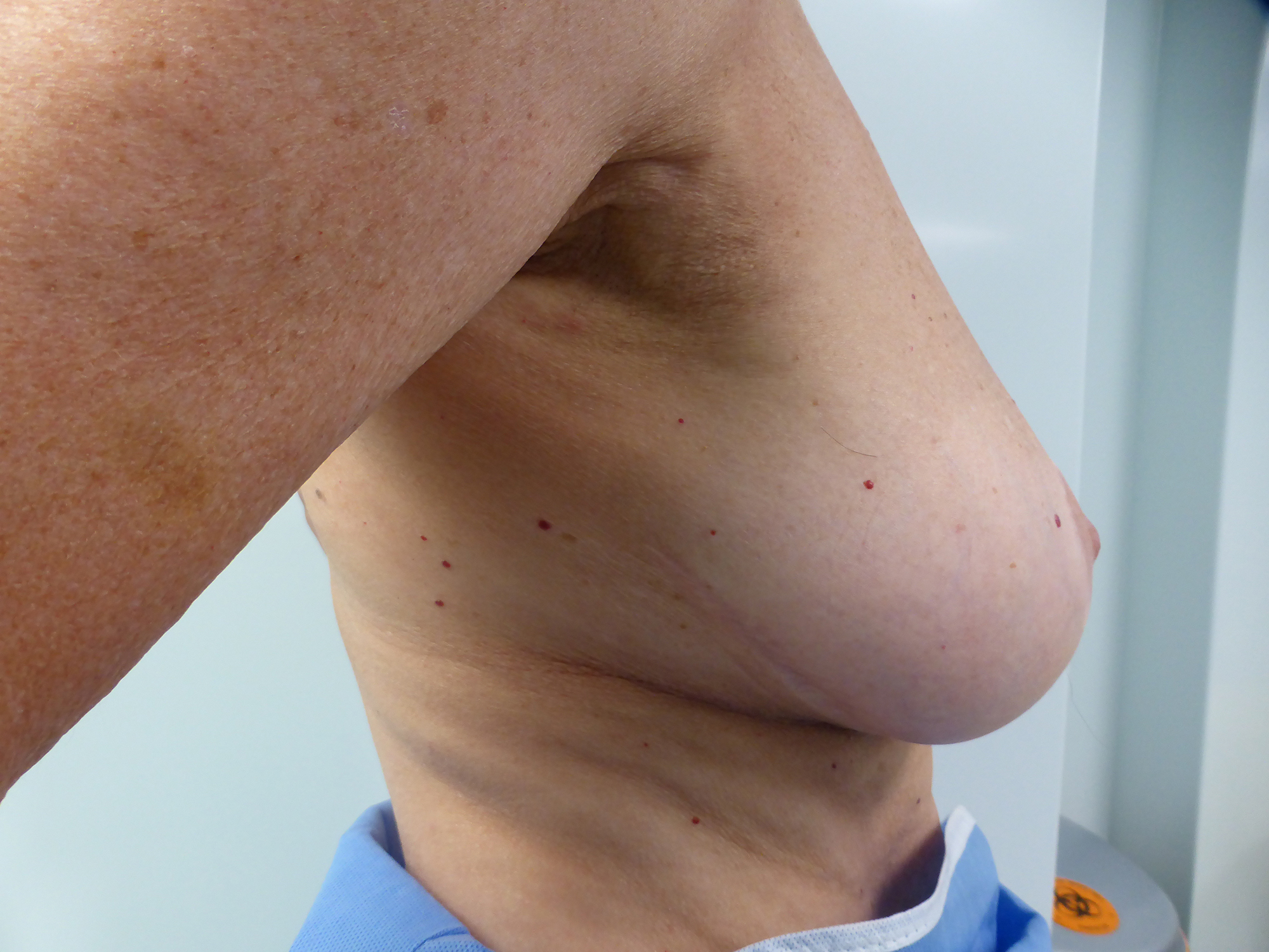 breast-liposuction-side-before - Dr Puneet Gupta - Breast Reduction -  Lipoedema - LiposuctionDr Puneet Gupta - Breast Reduction - Lipoedema -  Liposuction