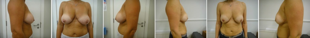 breast reduction in london
