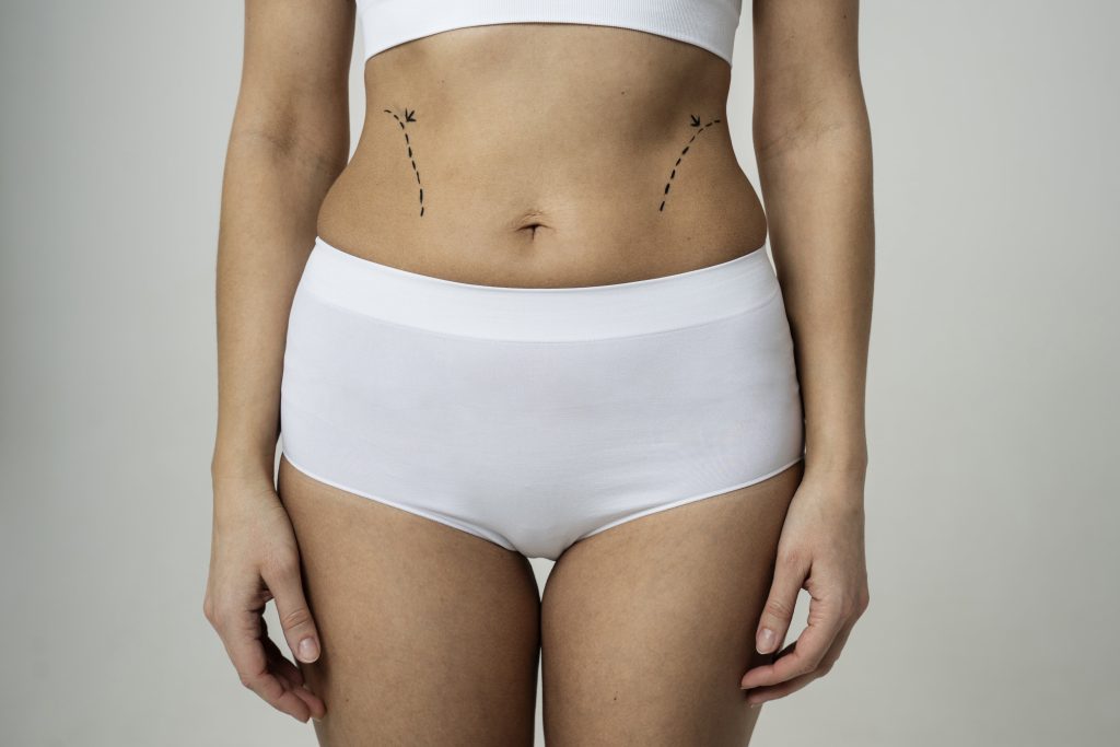 Best Lipoedema Surgeon in UK