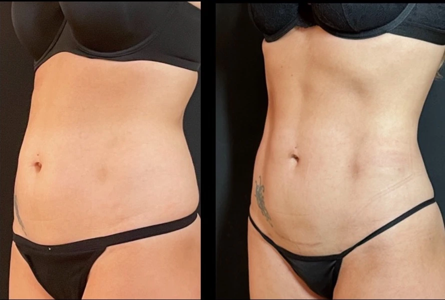 Liposuction in London