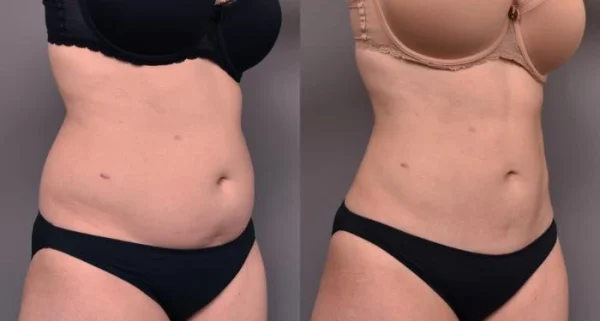 Liposuction in London