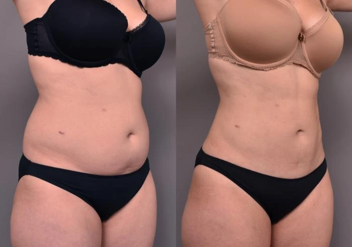 Liposuction in London
