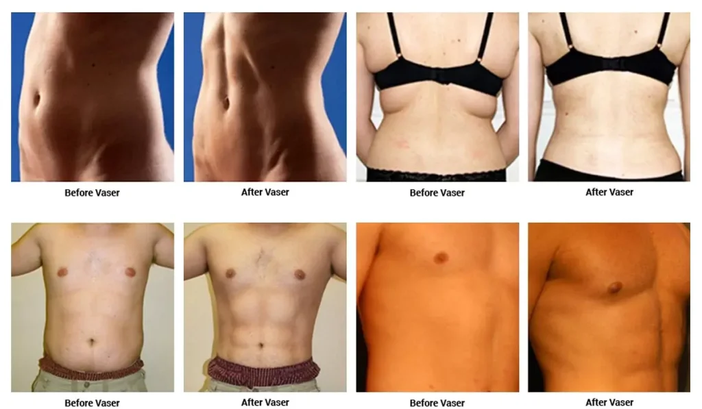 vaser liposuction specialist