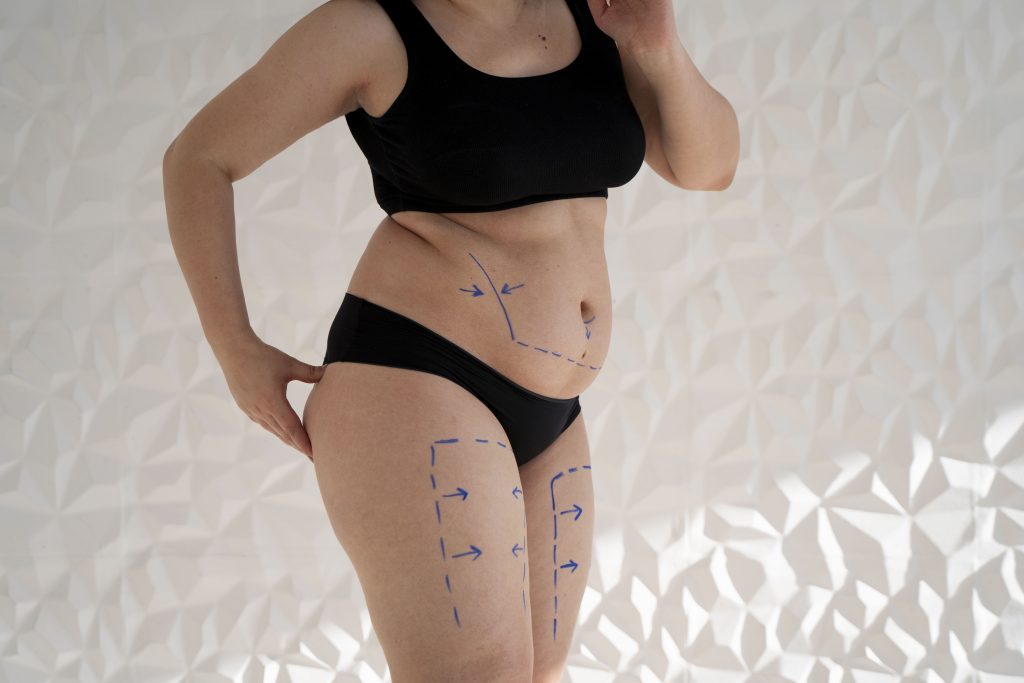 best lipoedema surgeon in UK