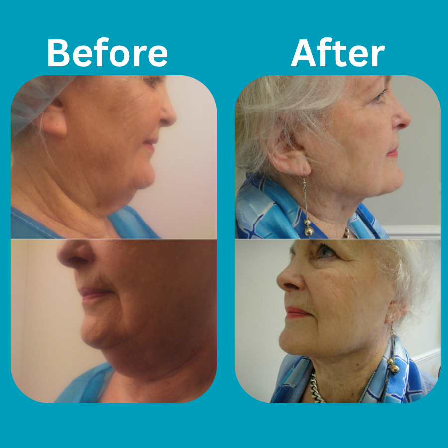 Double Chin Liposuction