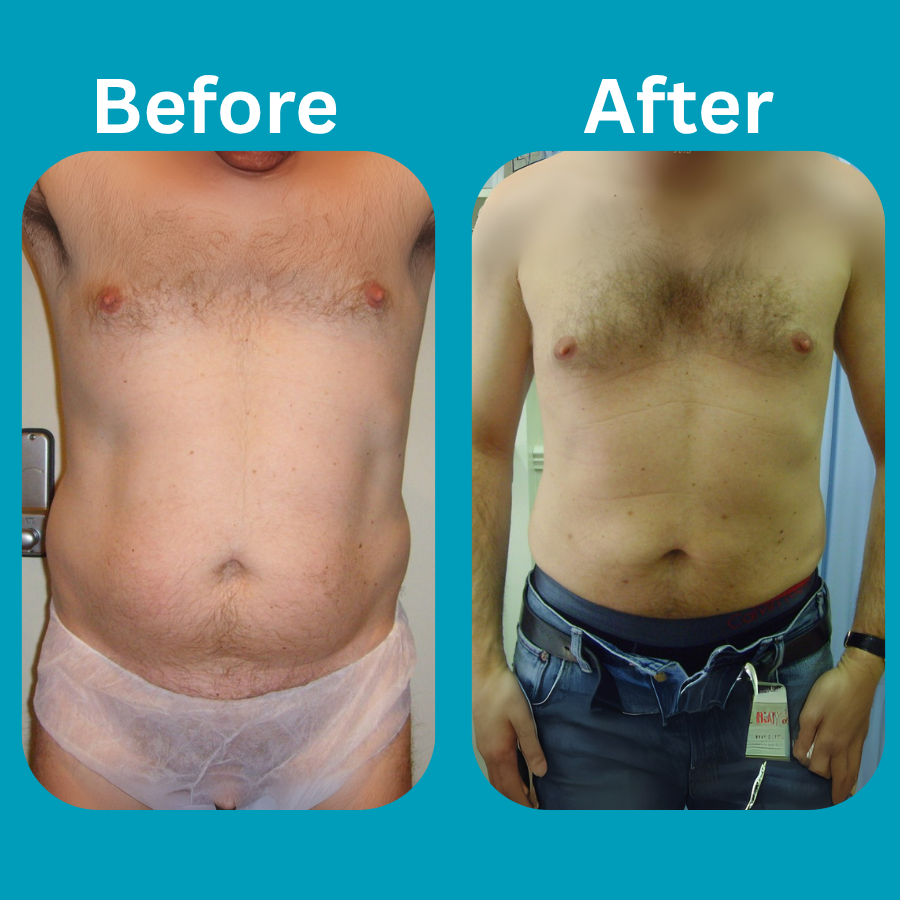 microlipo before and after