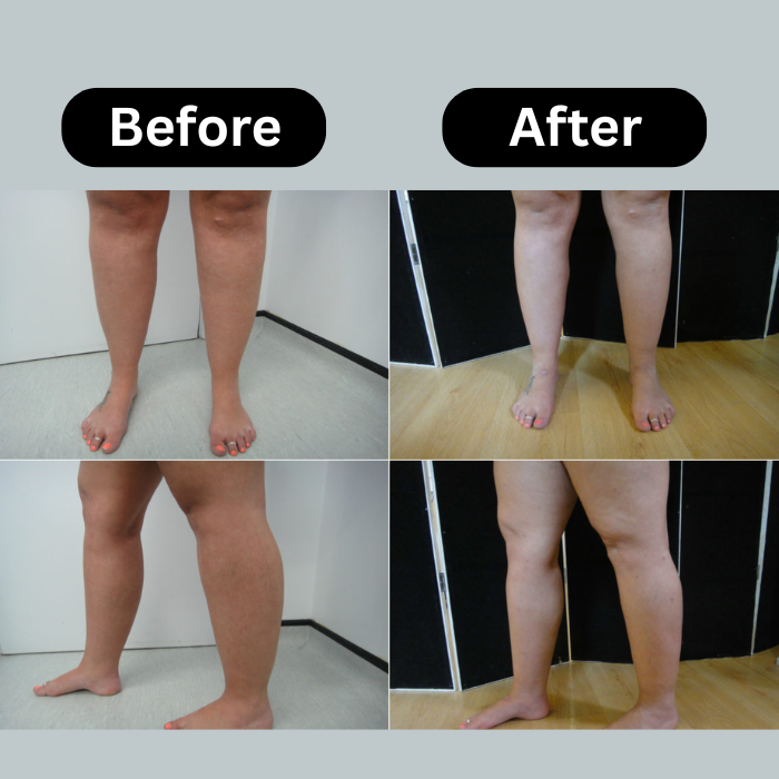 lymphoedema before and after