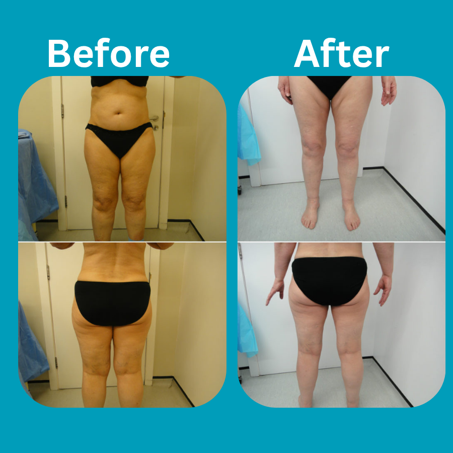 Lipoedema before and after