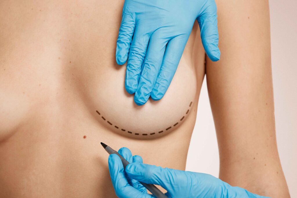 breast reduction